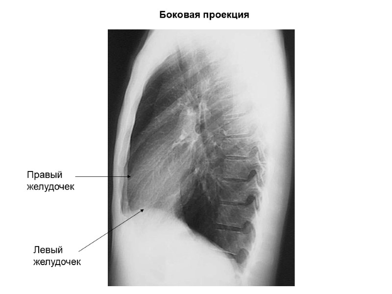 Боковая проекция Правый желудочек Левый желудочек